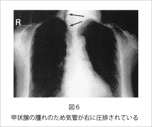 甲状腺の腫れのため気管が右に圧排されている