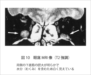 眼窩MRI画像