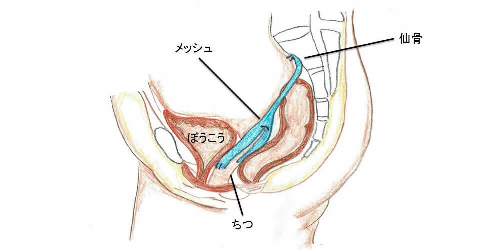 腹腔鏡下仙骨膣固定術（LSC手術）