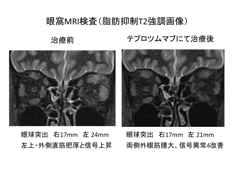 thyroid eye disease.png